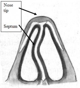 Deviated Septum