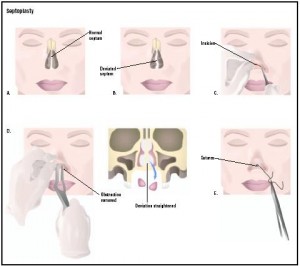 Deviated Septum- Septoplasty Procedure