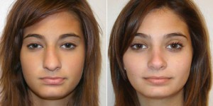 rhinoplasty for a deviated septum