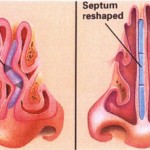 septoplasty septoplasty