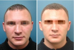 Septorhinoplasty