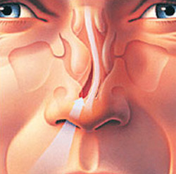 Deviated-nasal-Septum Deviated-nasal-Septum
