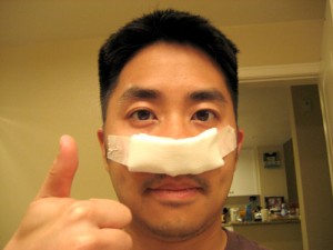 Septoplasty. Septoplasty.