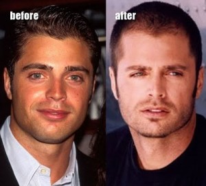 Celebrity Nose Jobs Celebrity Nose Jobs- The David Charvet Nose Job