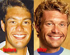Celebrity Nose Jobs Celebrity Nose Jobs- The Ryan Seacrest Nose Job