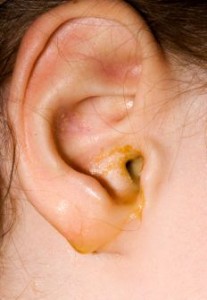 Deviated Septum and Ear Infections.jpg