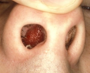 Possible Complications of Deviated Septum Surgery.jpg