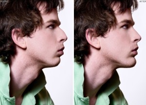 3 Types of Rhinoplasties.jpg