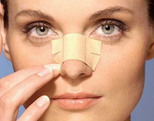 Nasal Tip Swelling Post Rhinoplasty.jpg