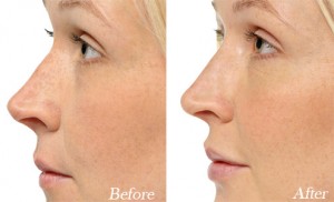 Hyaluronic Acid-Based Fillers for Non-Surgical Rhinoplasty.jpg