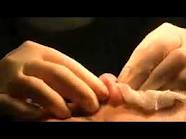 How To Prepare For A Septoplasty