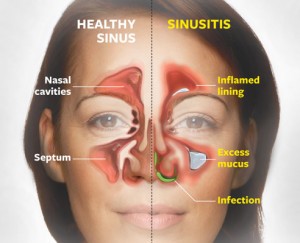 Acute Sinusitis.jpg
