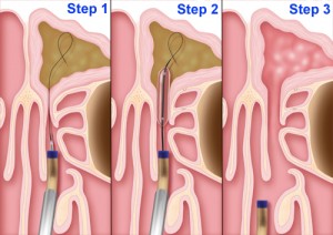 deviated septum