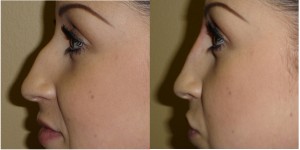 Deviated Septum - Nose Job