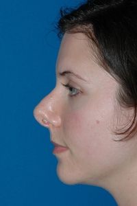 Revision Rhinoplasty
