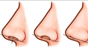 Non Surgical Nose Job Risks 2