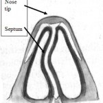 Septoplasty Surgery Instructions