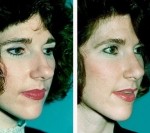 Deviated Septum-Before and After Septoplasty