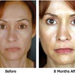 Deviated Septum Symptoms, Diagnosis and Treatment