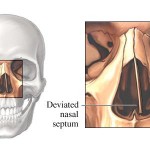 Symptoms, Diagnosis of a Deviated Septum