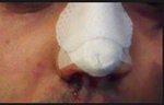 deviated septum suregery patient recovery