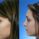 The Positives and Negatives of Deviated Septum Surgery