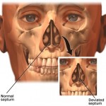 What is a Deviated Septum?