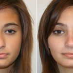 Rhinoplasty and a Deviated Septum