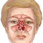 What is a Submucosal Resection or SMR?