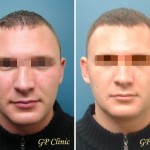 Septorhinoplasty Procedure, Uses & Recovery