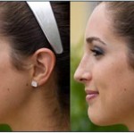 All you need to know about Rhinoplasty