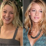 Blake Lively Nose Job Before & After