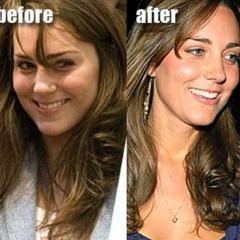 Kate Middleton Nose Job – Before & After