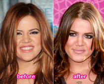 Khloe Kardashian Nose Job