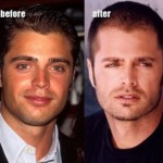 David Charvet Nose Job