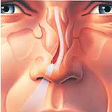 Does Deviated Septum Surgery Cure Sleep Apnea