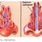 Side Effects of Deviated Septum Surgery