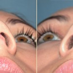 Benefits of Correcting Your Deviated Septum