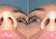 Benefits of Correcting Your Deviated Septum