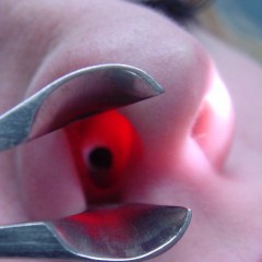 Possible Complications of Deviated Septum Surgery