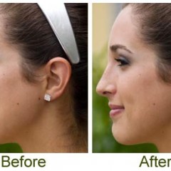 What is Closed Rhinoplasty?