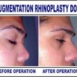 Augmentation Rhinoplasty