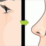 Autologous Cartilage Graft Rhinoplasty