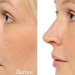 Hyaluronic Acid-Based Fillers for Non-Surgical Rhinoplasty