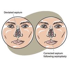 How To Prepare For A Septoplasty - Deviated Septum Information & Advice