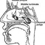 Septoplasty And Submucous Resection