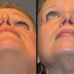 External Nasal Valve Collapse and Functional Rhinoplasty