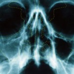 Sinusitis Complications
