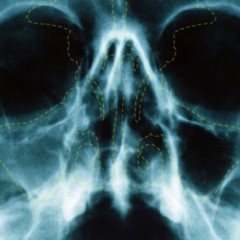 Sinusitis Complications