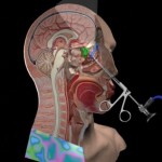 Endoscopic Sinus Surgery Complications